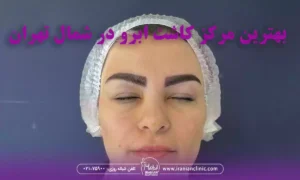 بهترین مرکز کاشت ابرو در شمال تهران