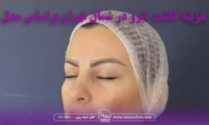 هزینه کاشت در مرکز کاشت ابرو در شمال تهران
