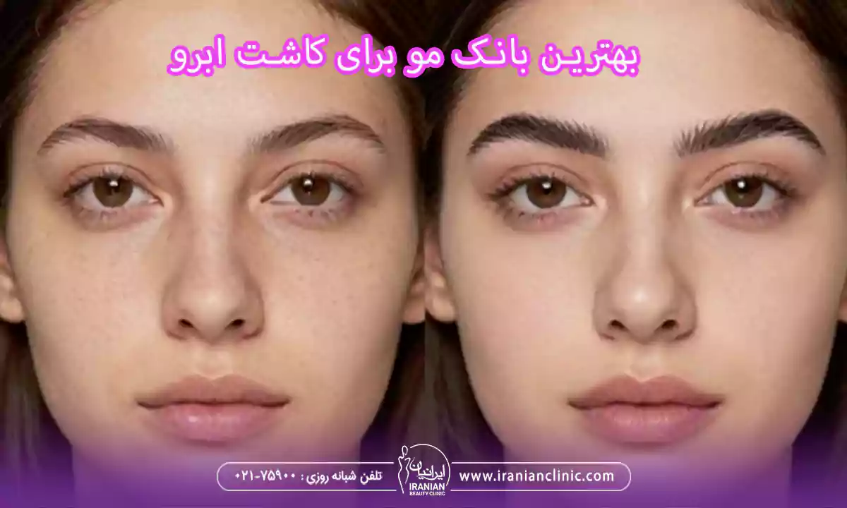 بهترین بانک مو برای کاشت ابرو