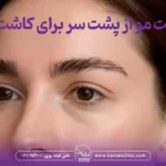 برداشت مو از پشت سر برای کاشت ابرو