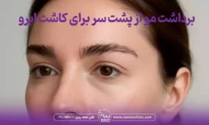 برداشت مو از پشت سر برای کاشت ابرو