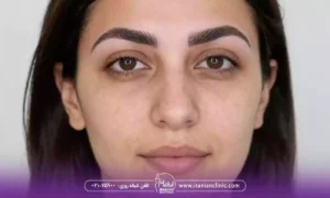 تفاوت موی پشت سر با سایر نواحی بدن برای کاشت ابرو