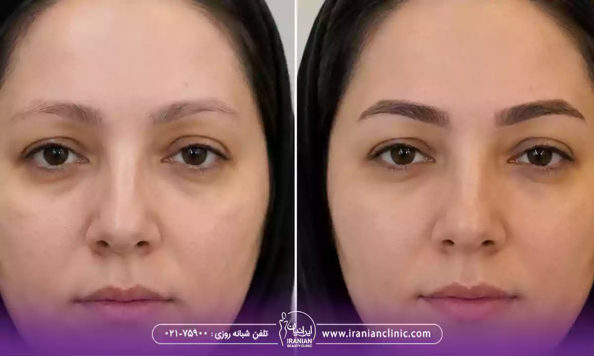 هزینه برداشت مو از پشت سر برای کاشت ابرو در تهران
