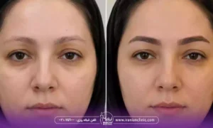 هزینه برداشت مو از پشت سر برای کاشت ابرو در تهران
