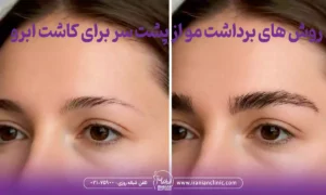 روش های برداشت مو از پشت سر برای کاشت ابرو
