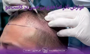 عوارض نادر اما جدی بی حسی در کاشت مو