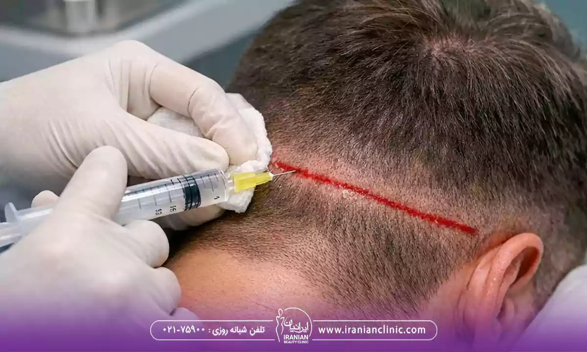 ۱۰ عوارض شایع آمپول بی حسی کاشت مو که ممکن است تجربه کنید!