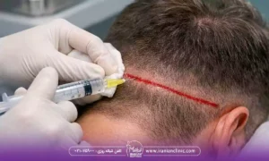 ۱۰ عوارض شایع آمپول بی حسی کاشت مو که ممکن است تجربه کنید!