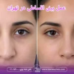 عمل بینی اقساطی و عمل قسطی بینی در تهران