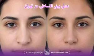 عمل بینی اقساطی و عمل قسطی بینی در تهران