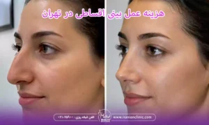 هزینه عمل بینی اقساطی و قیمت عمل قسطی بینی