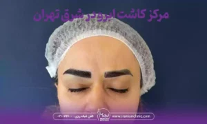بهترین مرکز کاشت ابرو در شرق تهران