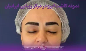 نمونه کاشت ابرو در مرکز کاشت ابرو در شرق تهران