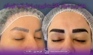 بهترین مرکز کاشت ابرو در زعفرانیه تهران