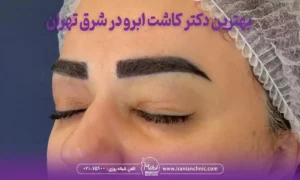 بهترین دکتر کاشت ابرو در شرق تهران