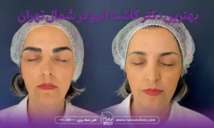 بهترین دکتر کاشت ابرو در شمال تهران