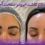بهترین دکتر کاشت ابرو در سعادت آباد تهران
