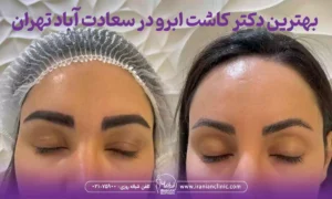 بهترین دکتر کاشت ابرو در سعادت آباد تهران