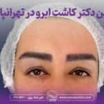 بهترین دکتر کاشت ابرو در تهرانپارس تهران