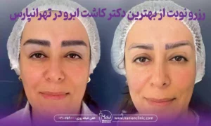 نحوه رزرو نوبت از بهترین دکتر کاشت ابرو در تهرانپارس تهران