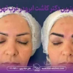 بهترین دکتر کاشت ابرو در غرب تهران
