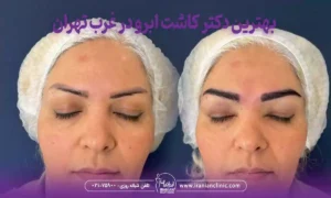 بهترین دکتر کاشت ابرو در غرب تهران