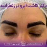 بهترین دکتر کاشت ابرو در زعفرانیه تهران
