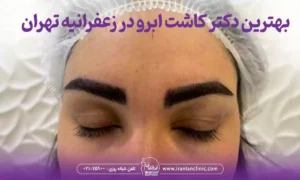 بهترین دکتر کاشت ابرو در زعفرانیه تهران