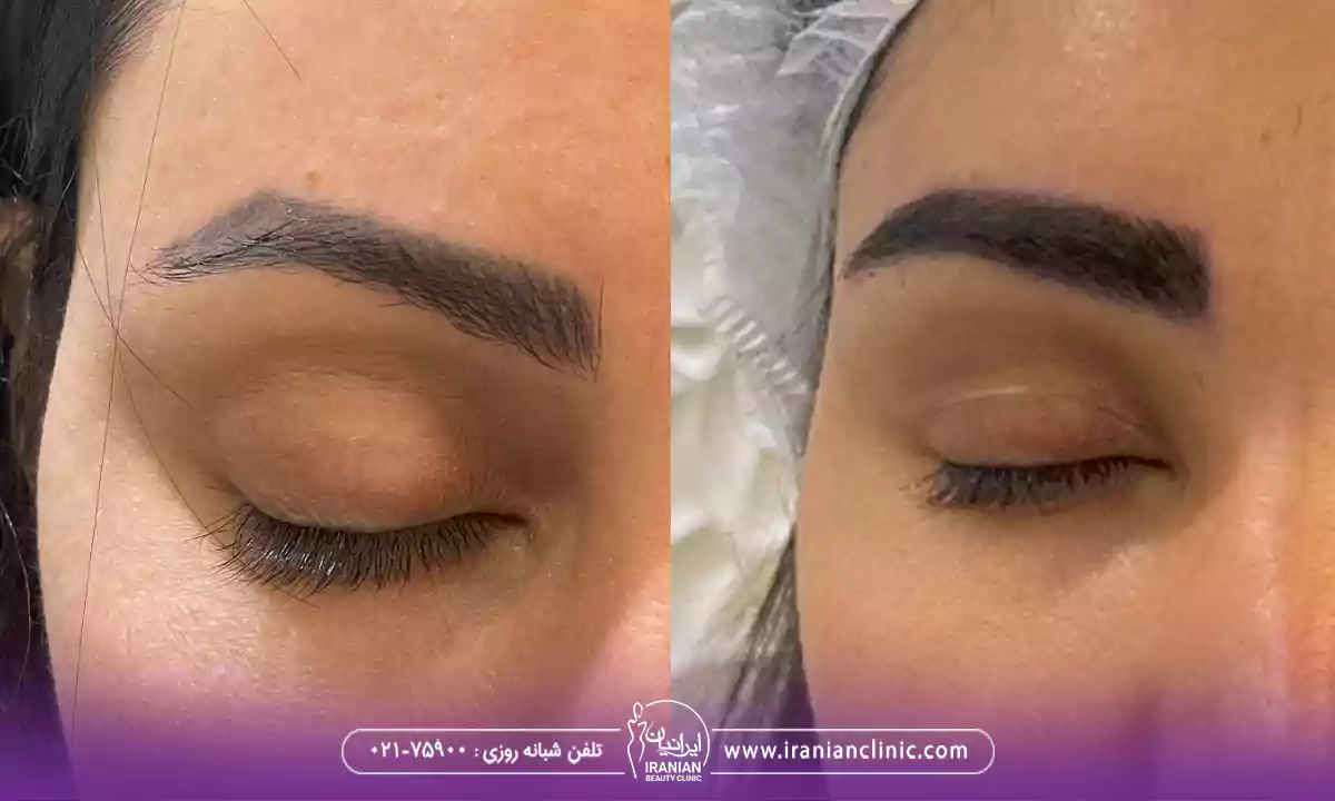 عکس قبل و بعد کاشت با بهترین دکتر کاشت ابرو در زعفرانیه تهران
