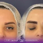 قیمت کاشت ابرو به روش fit و هزینه کاشت ابرو به روش FIT
