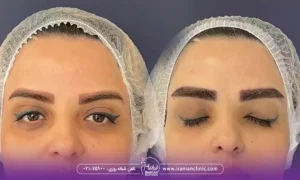 قیمت کاشت ابرو به روش fit و هزینه کاشت ابرو به روش FIT