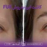 قیمت کاشت ابرو به روش FUE و هزینه کاشت ابرو به روش FUE