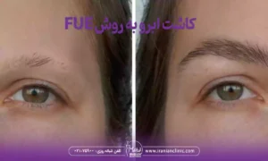 قیمت کاشت ابرو به روش FUE و هزینه کاشت ابرو به روش FUE