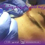 قیمت کاشت ابرو به روش fut و هزینه کاشت ابرو به روش FUT