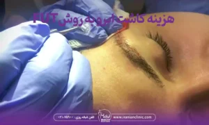 قیمت کاشت ابرو به روش fut و هزینه کاشت ابرو به روش FUT