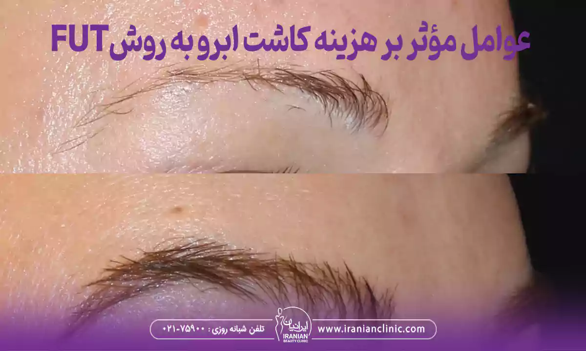 عوامل مؤثر بر هزینه کاشت ابرو به روش FUT