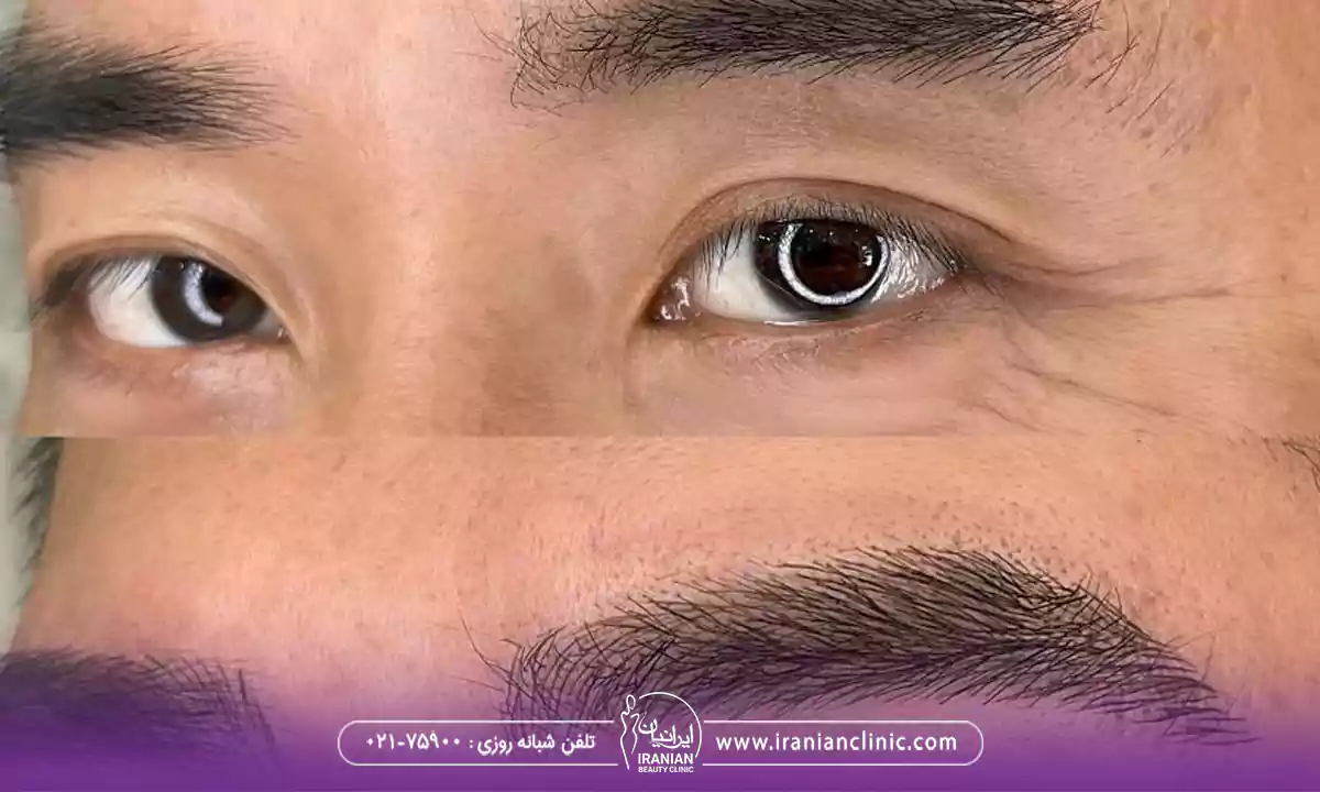 عوامل مؤثر بر هزینه کاشت ابرو مردانه