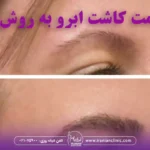 قیمت کاشت ابرو به روش sut و هزینه کاشت ابرو به روش SUT