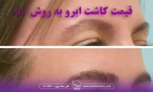 قیمت کاشت ابرو به روش sut و هزینه کاشت ابرو به روش SUT
