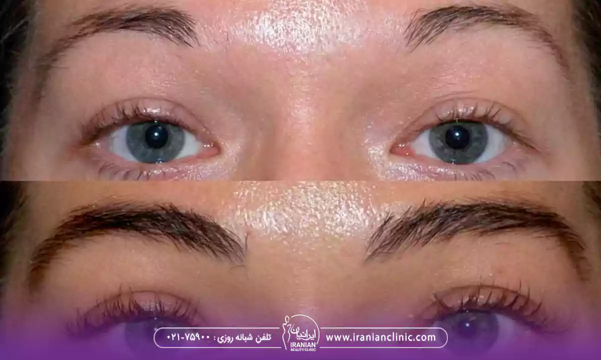 عوامل مؤثر بر هزینه کاشت ابرو به روش SUT