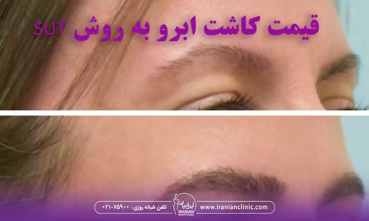 قیمت کاشت ابرو به روش sut و هزینه کاشت ابرو به روش SUT