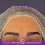 کاشت ابرو اقساطی و کاشت قسطی ابرو