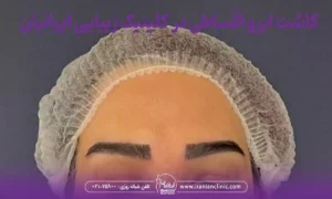 کاشت ابرو اقساطی و کاشت قسطی ابرو