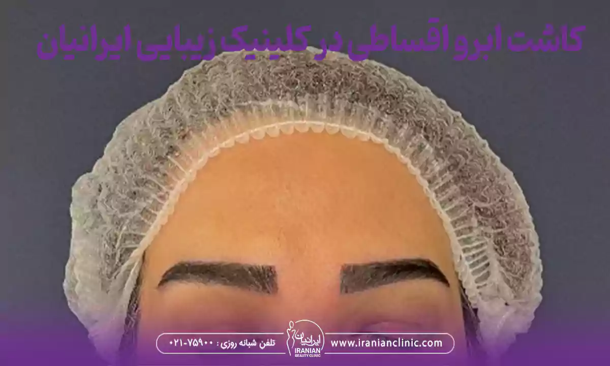 کاشت ابرو اقساطی و کاشت قسطی ابرو