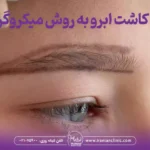 قیمت کاشت ابرو به روش میکروگرافت و هزینه کاشت ابرو میکروگرافت