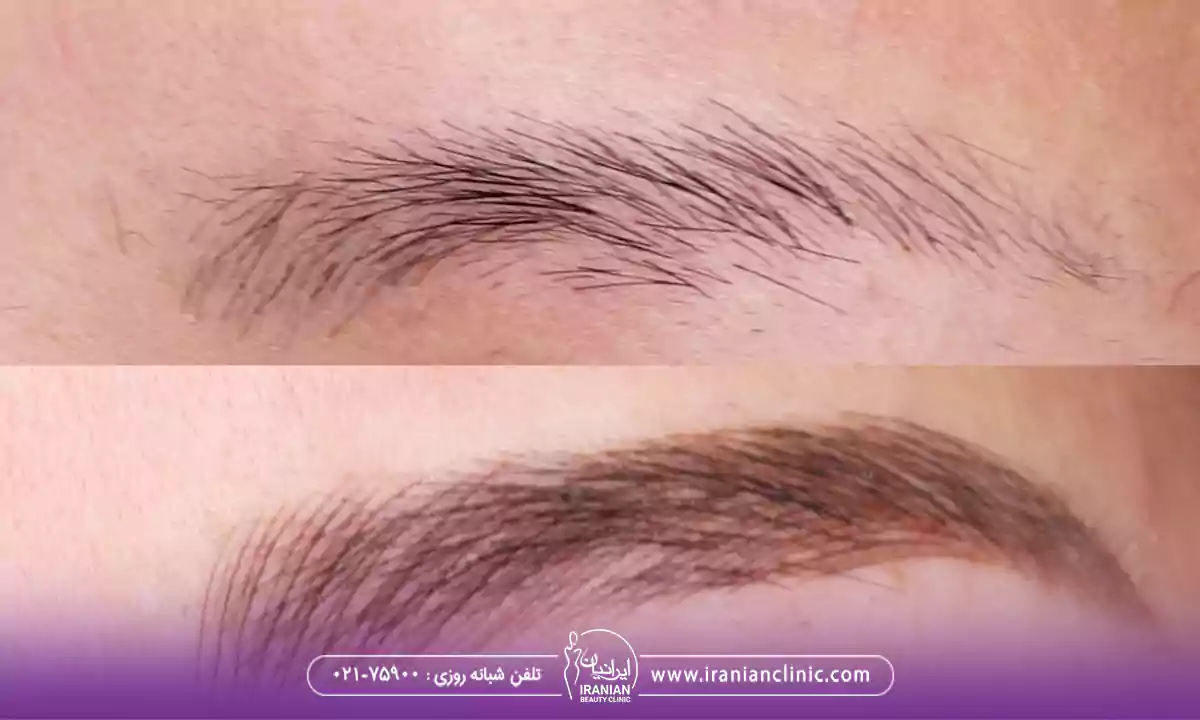 مقایسه هزینه کاشت ابرو به روش میکروگرافت با دیگر روش ها