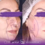 بهترین دکتر اندولیفت در شمال تهران