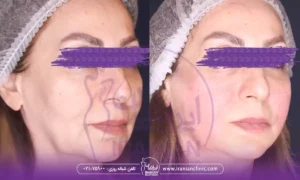 بهترین دکتر اندولیفت در شمال تهران