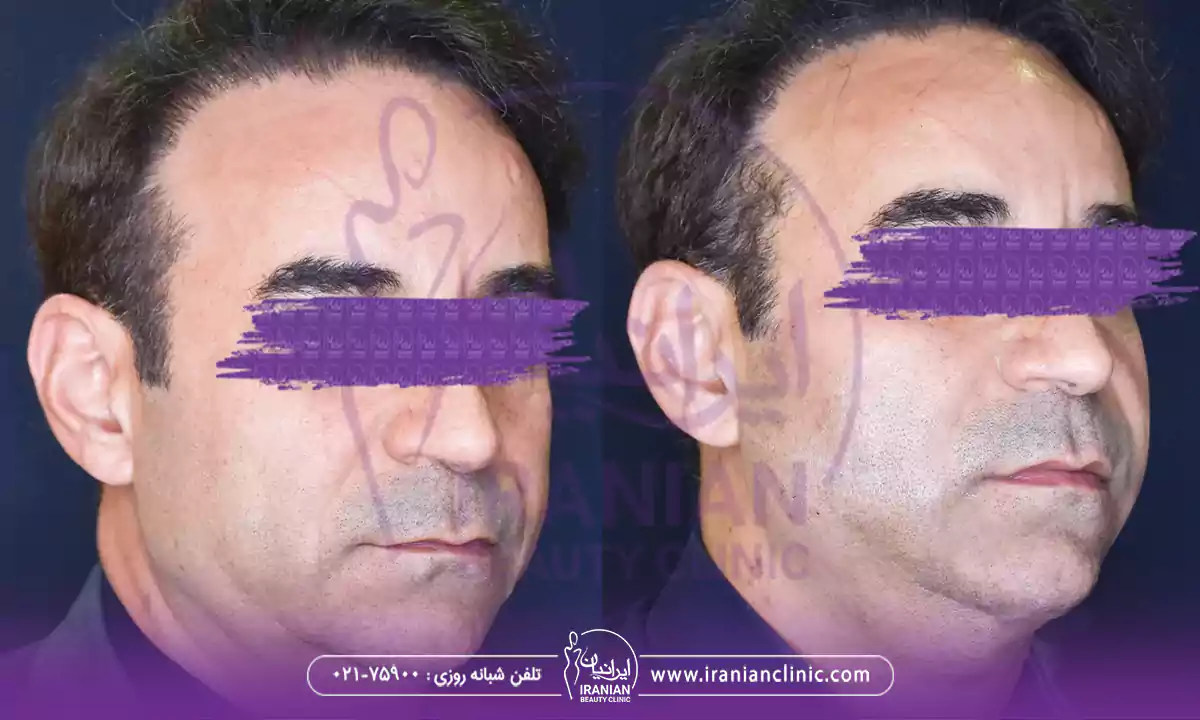 بهترین دکتر اندولیفت در شمال تهران چه خدماتی ارائه میدهد؟
