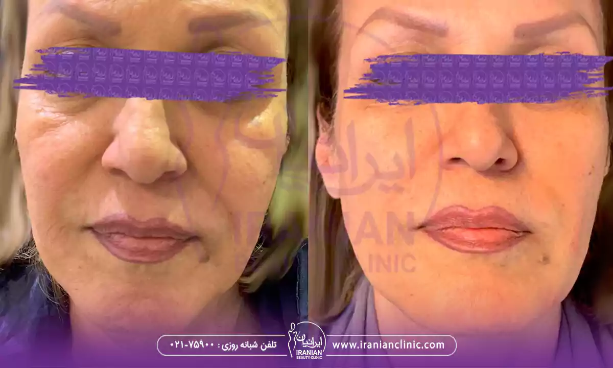 هزینه اندولیفت با بهترین دکتر اندولیفت در شمال تهران